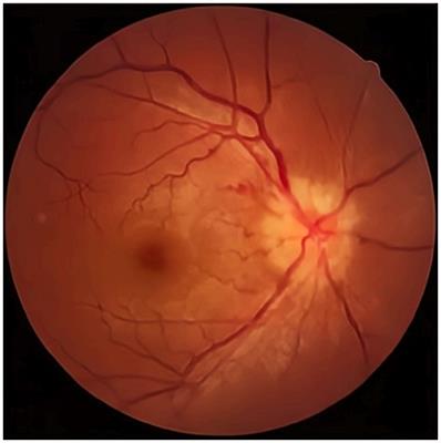 A case report of neurosyphilis coexisting with a positive MOG antibody manifested as optic neuritis